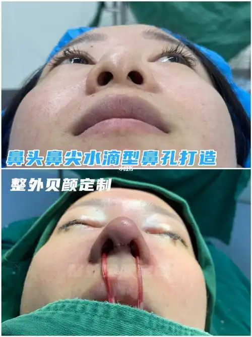 99【水滴型鼻孔】打造术后即刻_美妆_医美_整容_美妆_医美整形