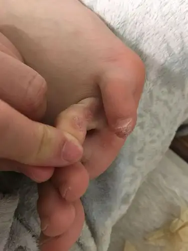 之前很小很少,看了一次说是病毒疣,做了冷冻,孩子怕疼只冷冻了一次就