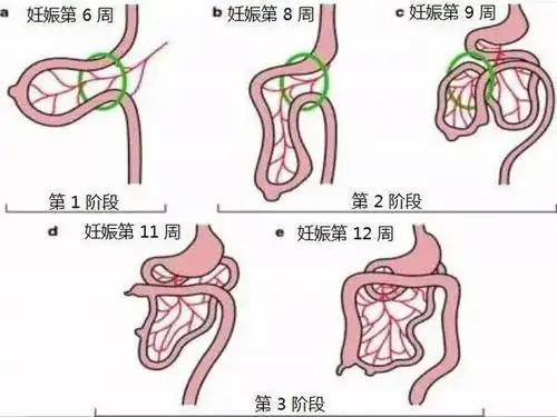 先天性肠旋转不良