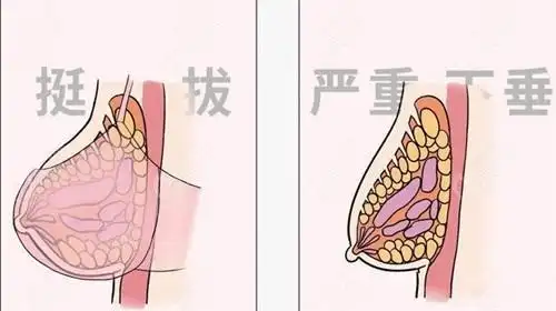 产后胸部韧带撕裂下垂厉害做人工韧带乳房提升能修复吗