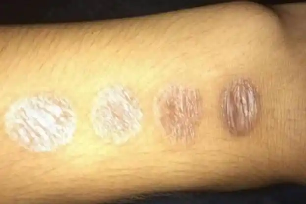 烟烫伤留下的疤痕可以治疗修复吗?