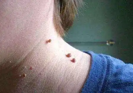 身上起疙瘩是怎么回事身上长小肉粒是怎么回事怎么治