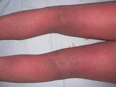 用什么方法可以护理红皮病_红皮病_北京京城皮肤病医院(北京医保定点