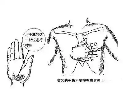生死竞速---心肺复苏术