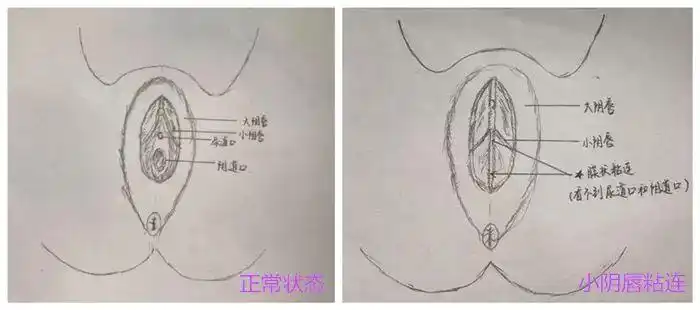 1岁女宝宝居然得妇科病还动了手术