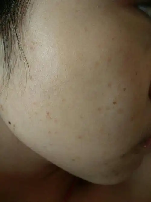 我的右半边脸上有很多褐色的斑点,不知道是什么?可以去掉吗?