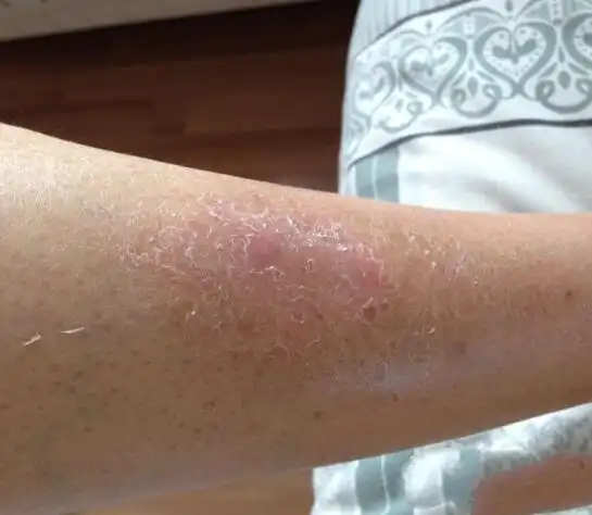 银屑病脱皮好转的图片_银屑病求医网