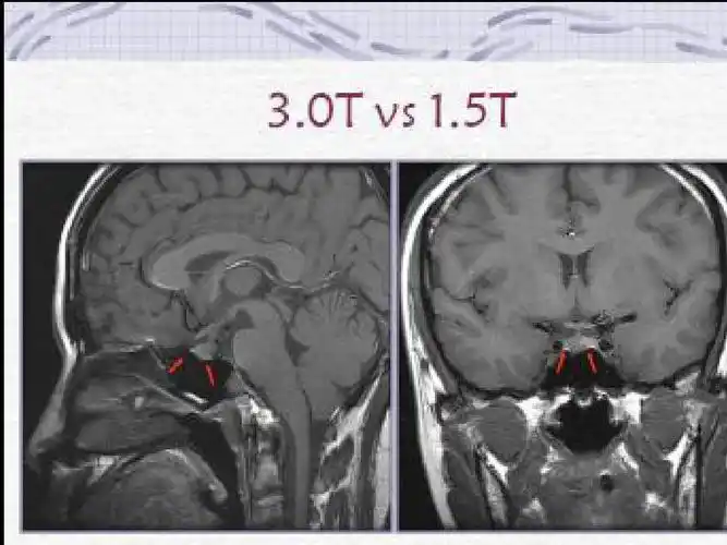 垂体病变的mri诊断ppt
