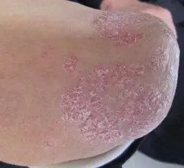 皮肤病有哪几种图片_银屑病求医网