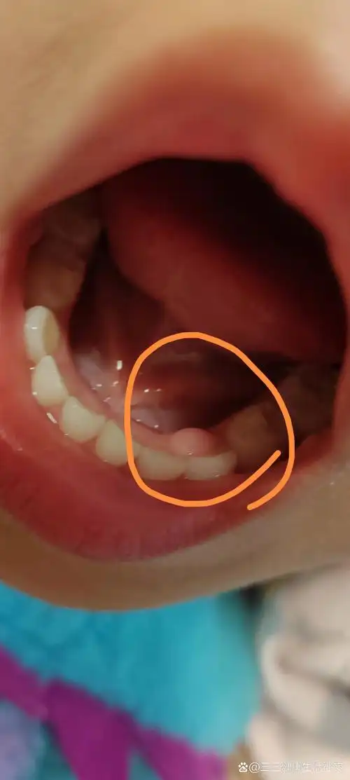 牙龈长了个包,不痛不痒