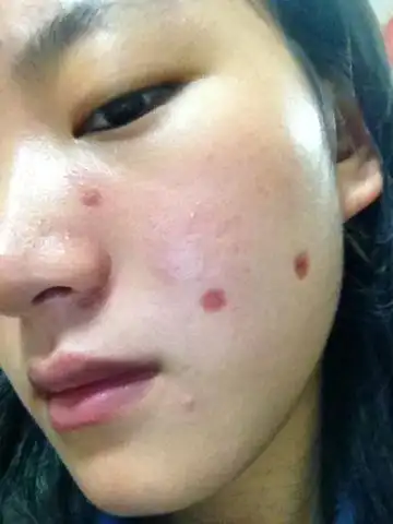 脸被药水点了字,都两个月了还没好,怎么办?能好吗?