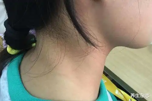 如果平时在脖子上出现异常,没有明显的疼痛感,一定要引起注意,及时到