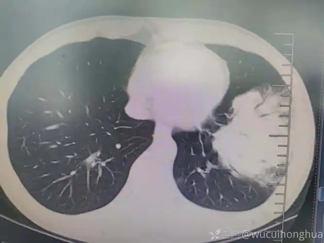 典型的大叶性肺炎