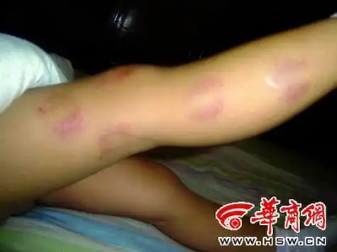 2岁女童幼儿园被咬伤 受刺激怕生人夜晚做恶梦
