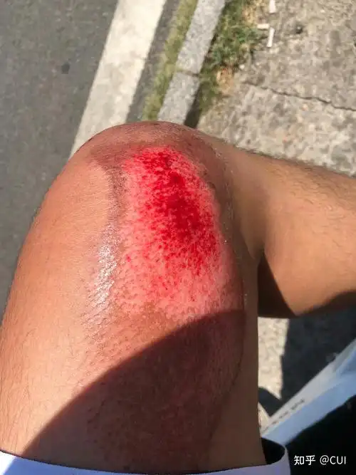 骑车摔倒腿部擦伤后,伤口愈合记录 - 知乎