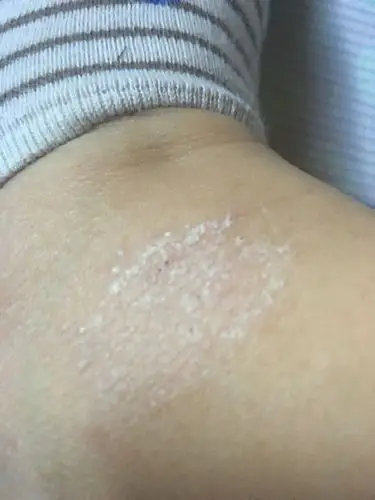 有没有皮肤科医生 咨询个事 我这几个月手上和脚踝上长这个东西