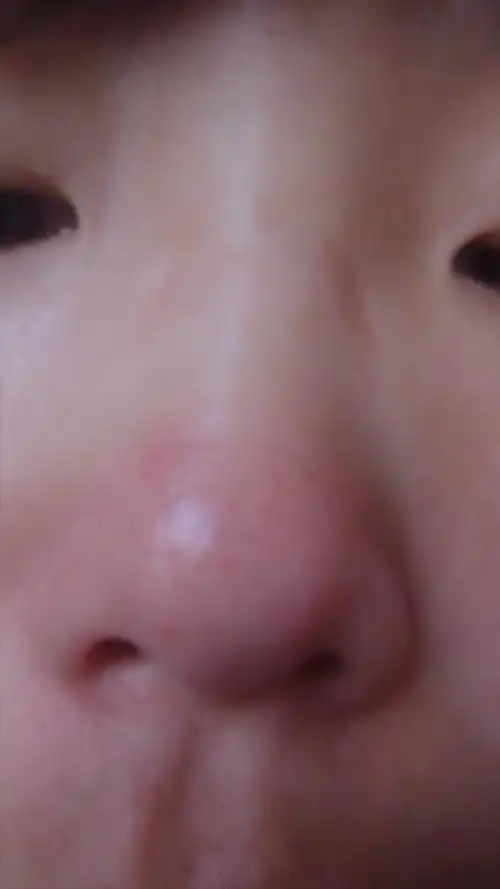 问:我的鼻尖总是在红,在17岁好像就有了,而且上面总是起粉刺,我想问一