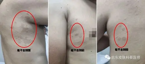 伍德灯之花斑癣_花斑癣_介绍_症状表现_日常注意事项 - 好大夫在线