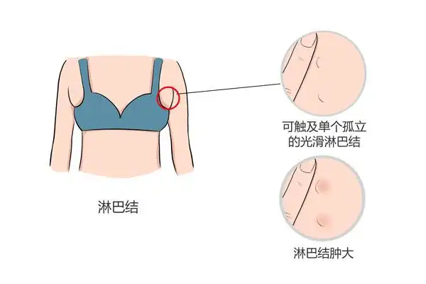 如何辨别副乳和淋巴结