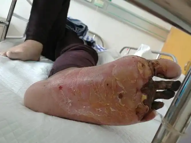 糖尿病足不容忽视_糖尿病足_疾病介绍_介绍 - 好大夫在线