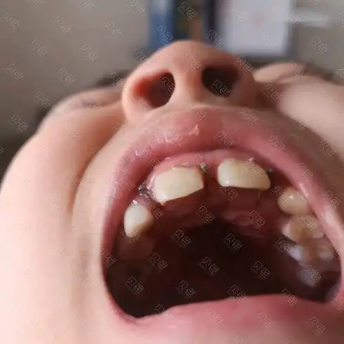 儿子门牙多生牙埋伏牙终于拔出住院天总计花费一万二