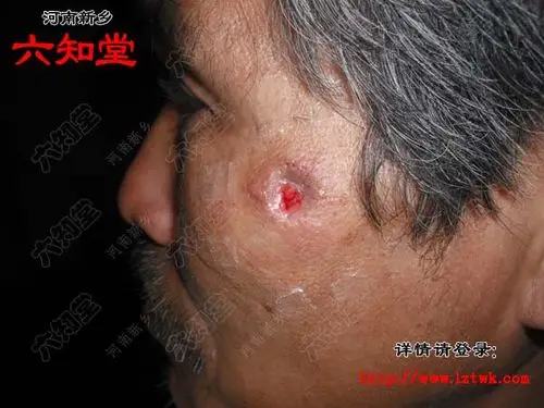 皮脂腺囊肿(粉瘤)被中医治愈病例