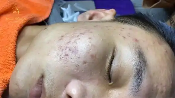 龙姑娘针挑黑头,闭口 0331-美妆视频-搜狐视频