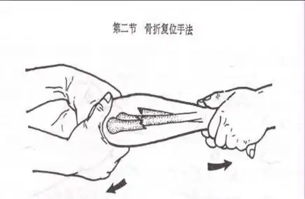 8种骨折复位手法操作技巧,你都掌握了吗?