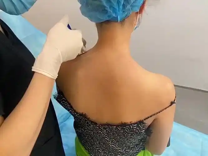 第一次来打瘦肩针,斜方肌挺发达的,穿衣服给人感觉就_圈子-新氧美容