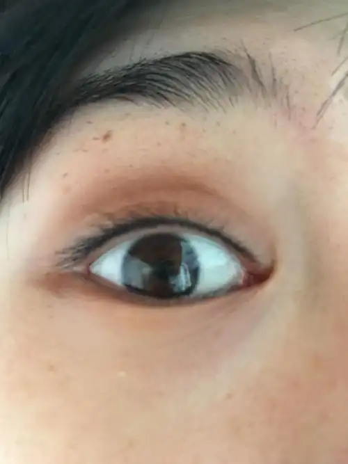 美瞳线补色后一个月,超级自然,没有变蓝