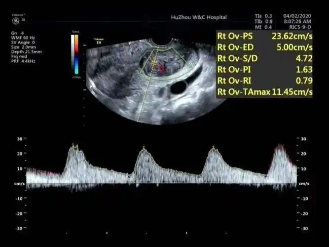 子宫炎性肌纤维母细胞瘤误诊 2 例_诊断_肿瘤_病例