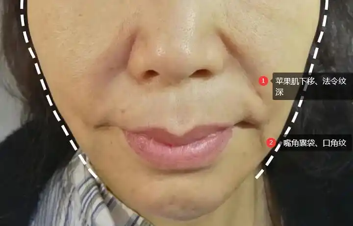 50岁,法令纹和木偶纹明显,面部提升能改善吗?