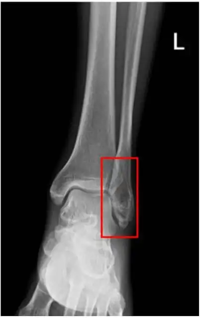 右侧胫腓骨远端似见横行骨折透亮线,断端对位对线尚可然而,一个优秀的