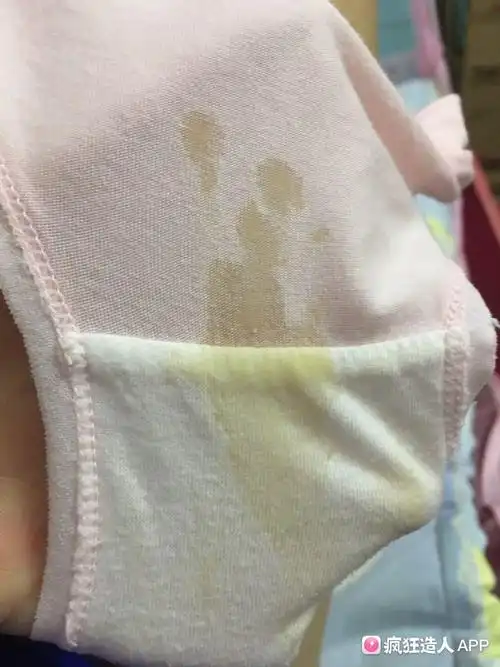 孕七周 和孕十周 ,都出现黄色分泌物流出,起初水状,干后黄黄的,边缘水