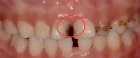 深圳罗湖门牙邻面龋补牙多少钱