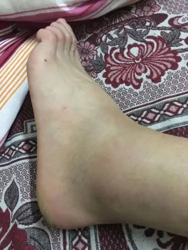 昨天打篮球崴脚,当时就肿了,但是能勉强走路,回到家感觉越来约疼了,就