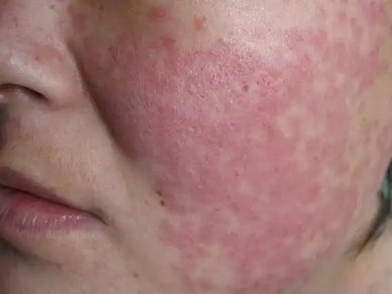 红斑狼疮是什么病图片