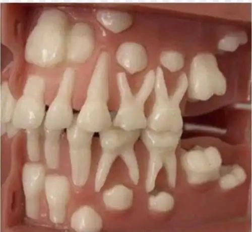 治疗的原因,也是最重要的原因——乳牙龋齿可能导致恒牙出现各种问题