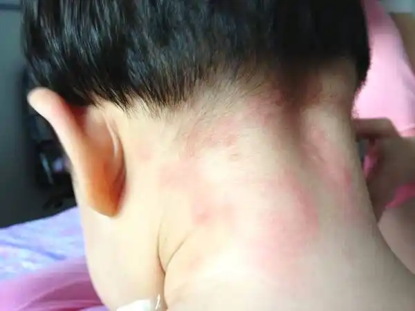 为什么只有晚上起风疹 为什么一到晚上就起风疹块