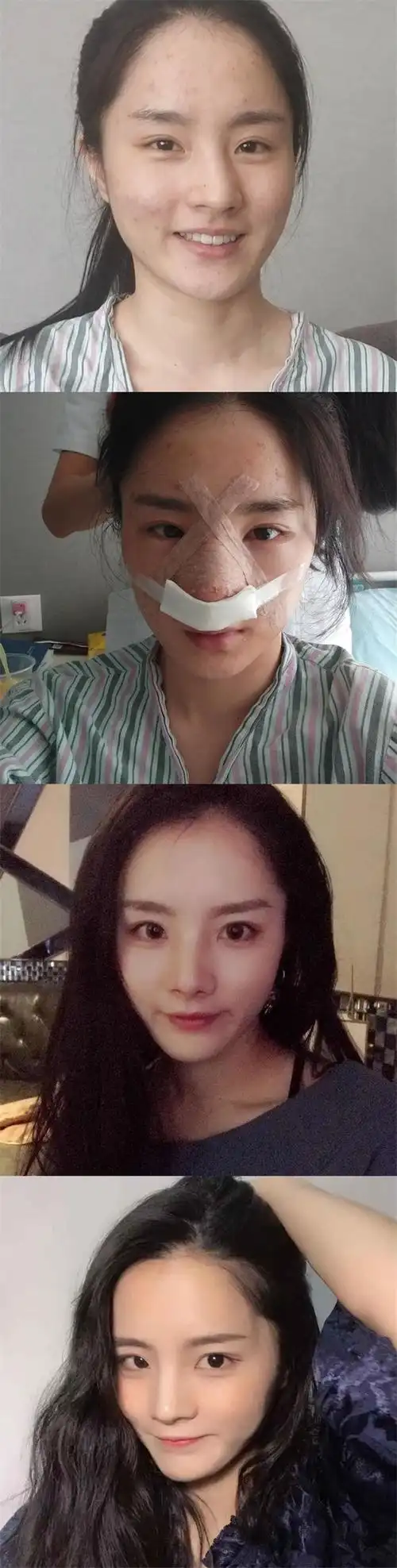 北京正美郑永生歪鼻矫正怎么样?案例价格