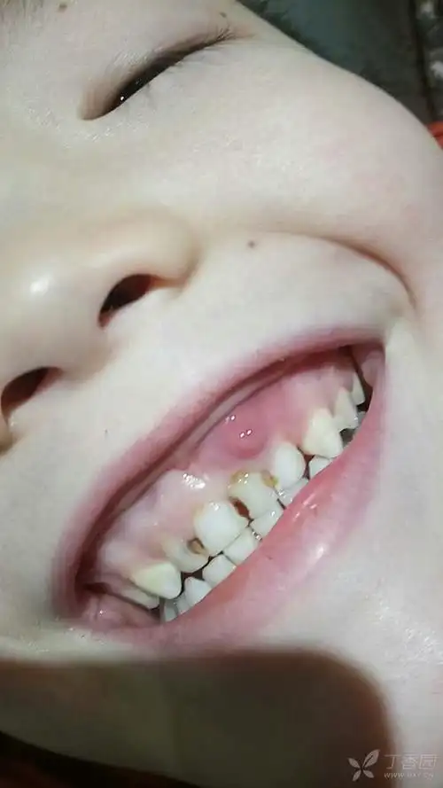 牙龈上是什么东西? [病例帖]