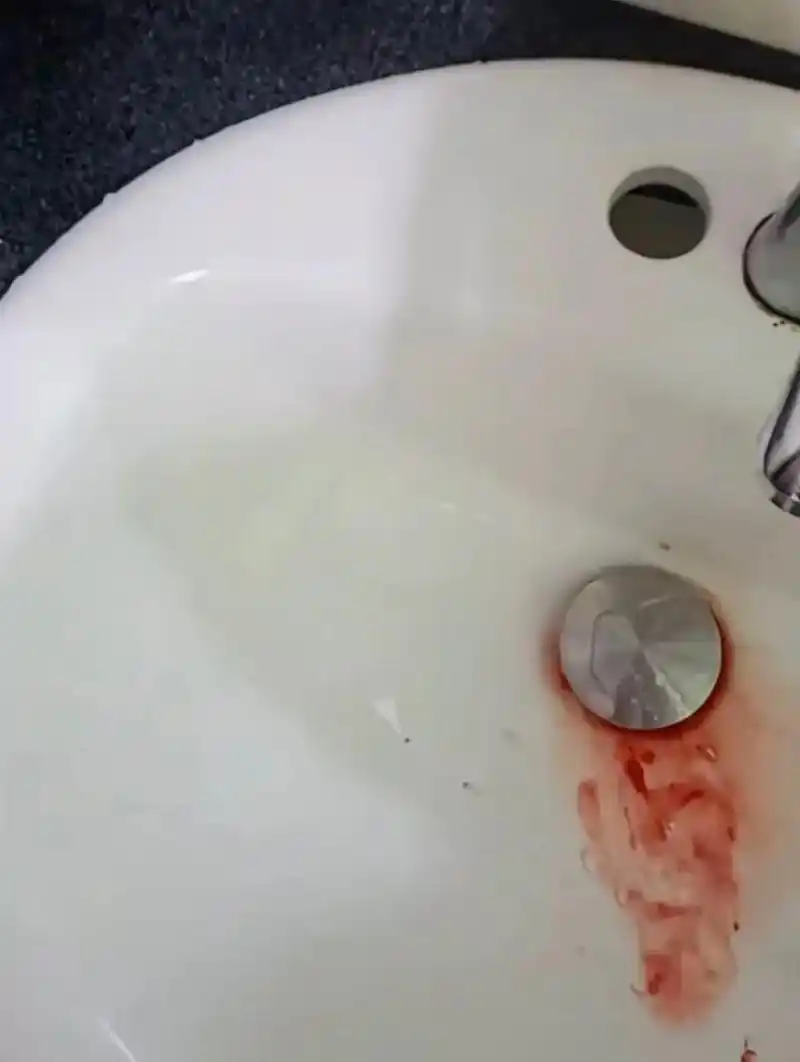 鬼门关走了一遭,阎王看我可怜没收我,喝酒喝到胃出血