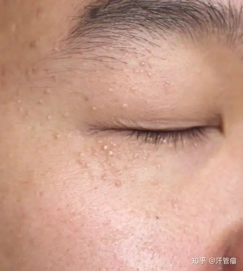 眼睛周围长汗管瘤是什么原因造成的!