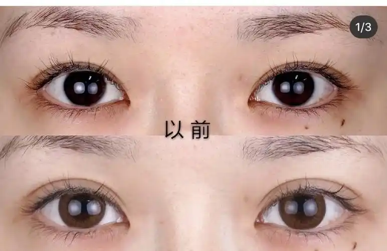 内双形双眼皮图片