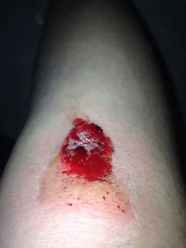 摔了以后又流血又流水,怎么回事