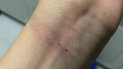 真的很疼,我下不去手了,只有一条细细的伤口……          赞同  添加