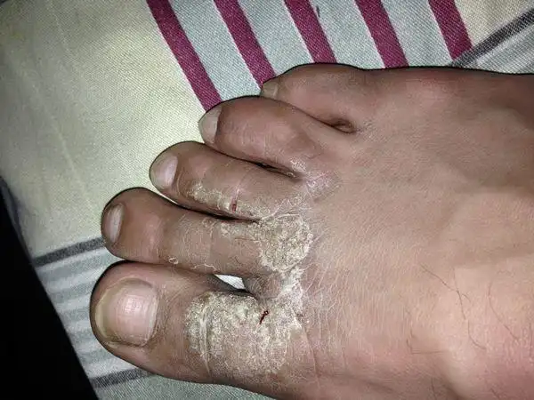 养生丨常见脚癣体癣用这种草药外搽23天可治愈