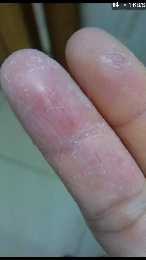 我这手指老是脱皮是什么皮肤病?