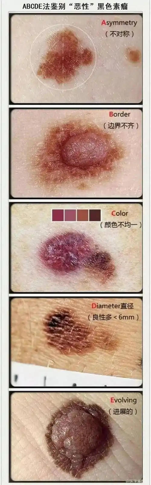 姑娘切痣查出癌!这种痣会害死人,赶紧对照自查吧