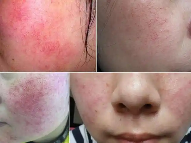 敏感肌肤怎样修复角质层精简护肤之道护肤越简单对皮肤越好